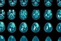 Melatonina: una aliada inesperada contra el tumor cerebral más agresivo