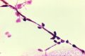 ¿Por qué la candidiasis vaginal continúa siendo un problema médico tan frecuente?