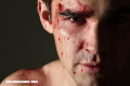 Extrañas Enfermedades: Hematidrosis ¿es posible sudar sangre?