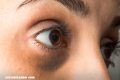10 alternativas naturales para eliminar las ojeras